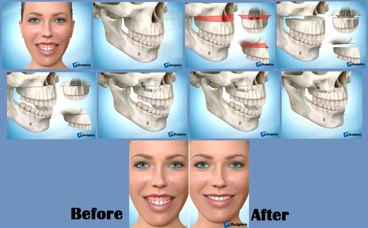 Maxillary_Impaction.jpg
